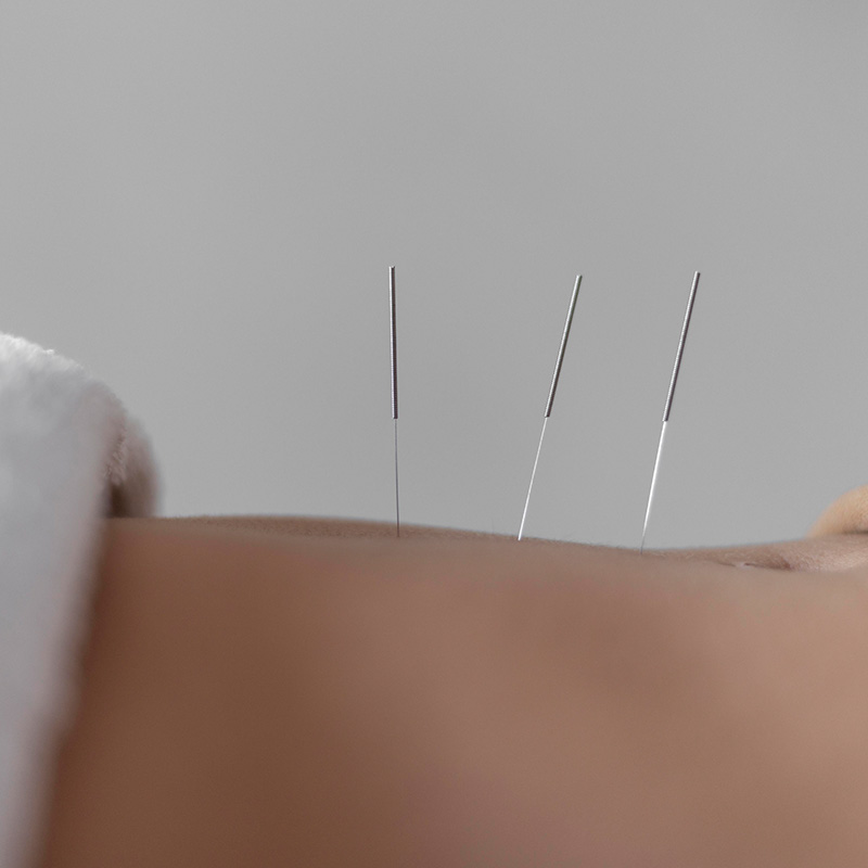 Dry Needling - Trigger Point Release